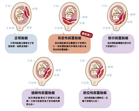 懷孕胎盤